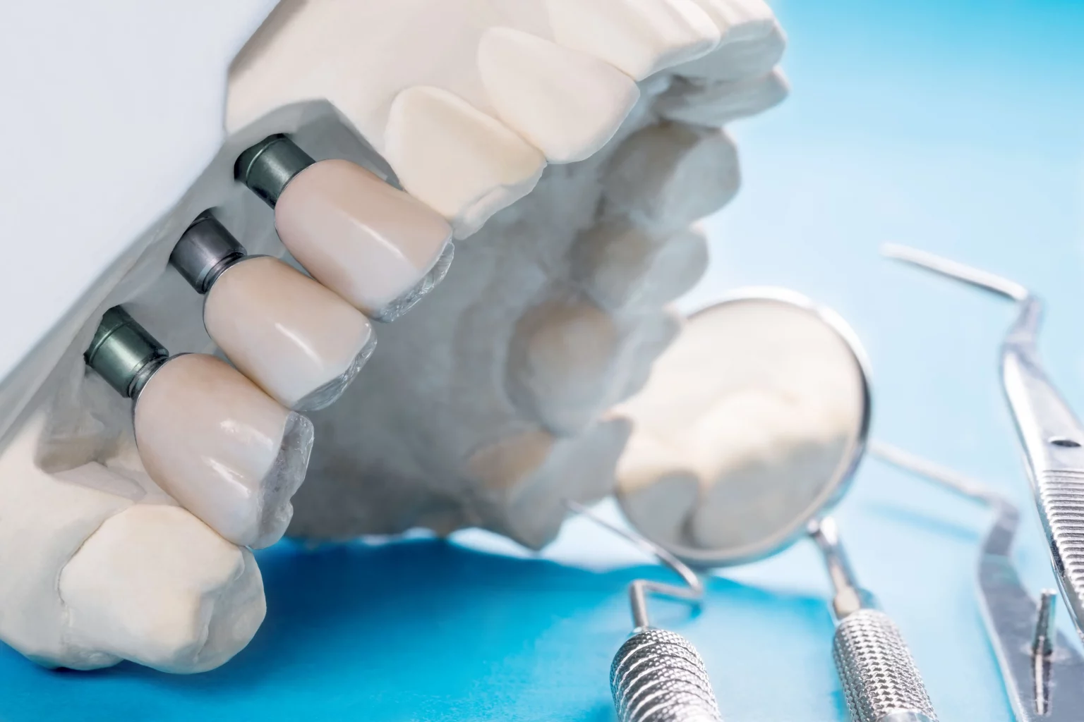 Cuánto Cuesta Un Implante Dental En Valencia clinica amedent