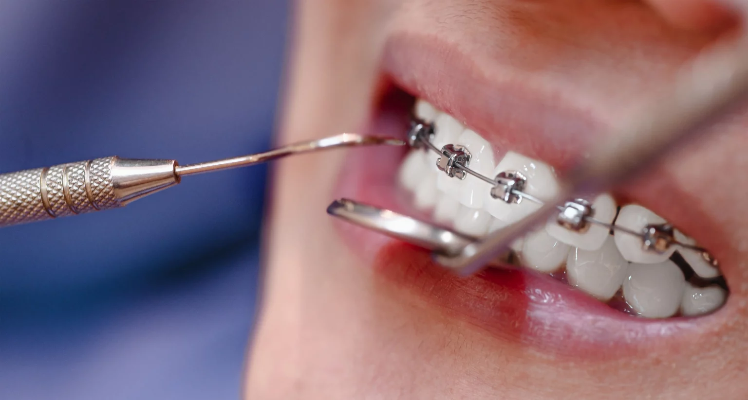 Ortodoncia Tip-Edge la técnica que reduce visitas y tiempo de tratamiento en valencia clinica dental amedent