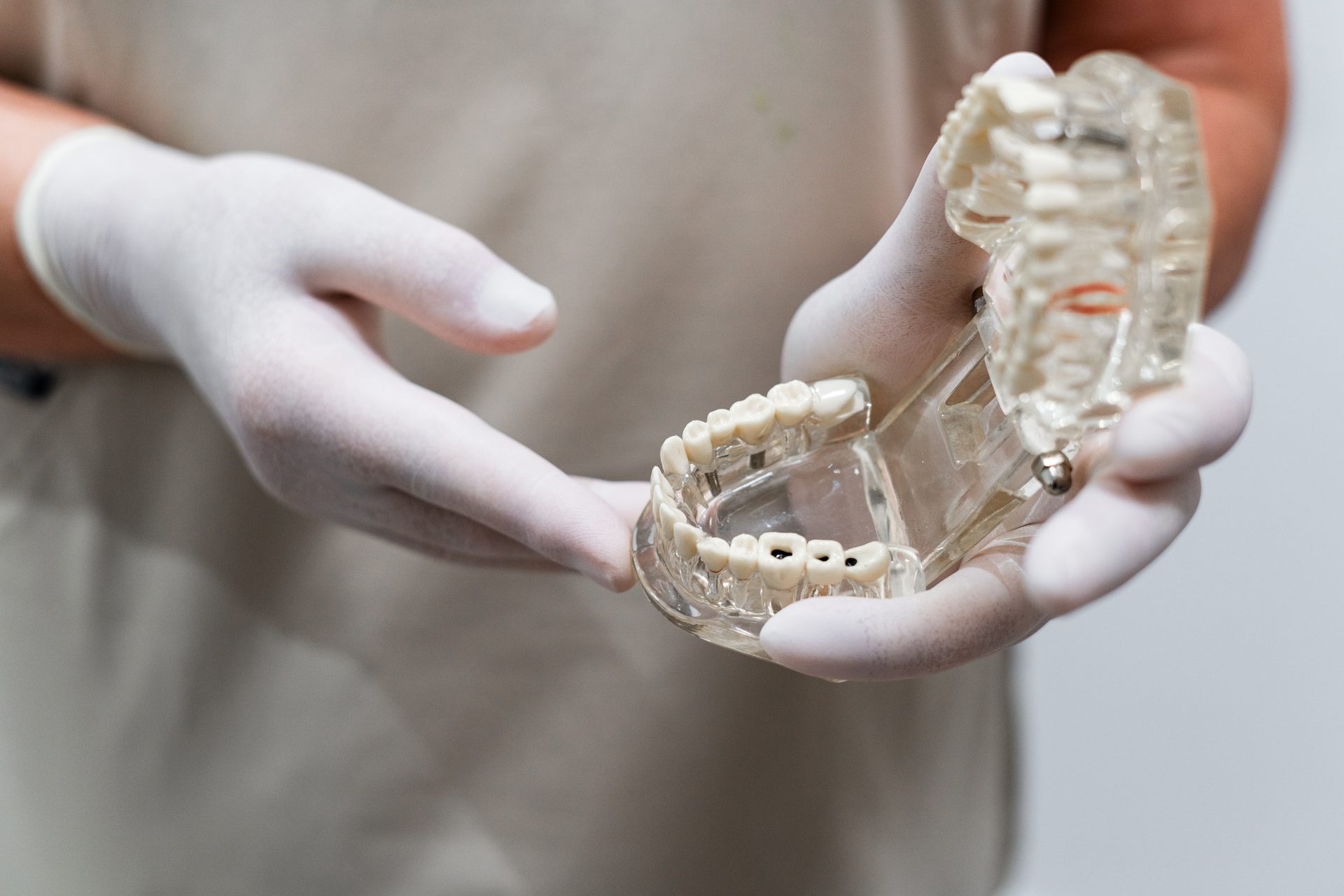 Modelo de prótesis dental sobre implantes