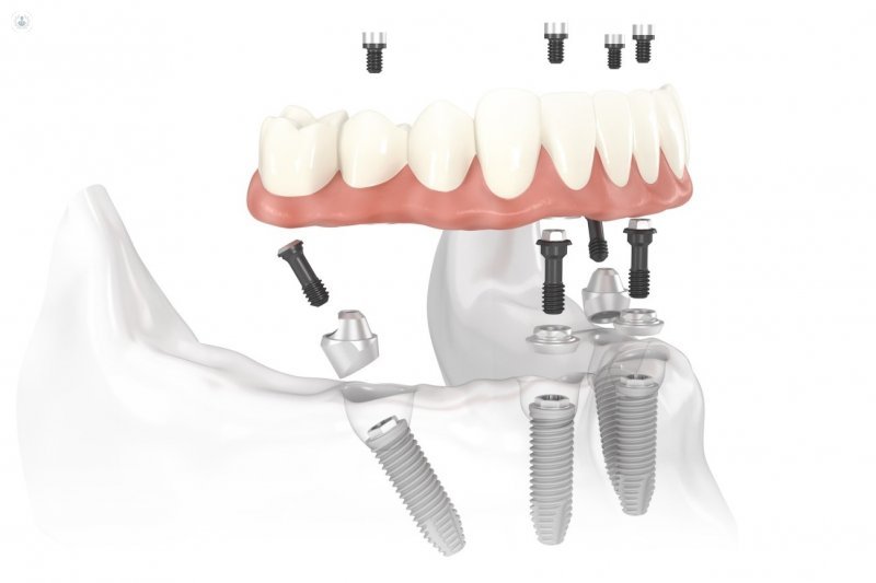 Amedent - Clínica Dental en Valencia|Las técnicas más sorprendentes de implantes dentales