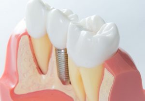 oferta de implantes dentales en valencia