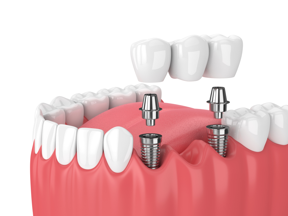 Amedent - Clínica Dental en Valencia|Puentes dentales fijos, la solución en la restauración dental