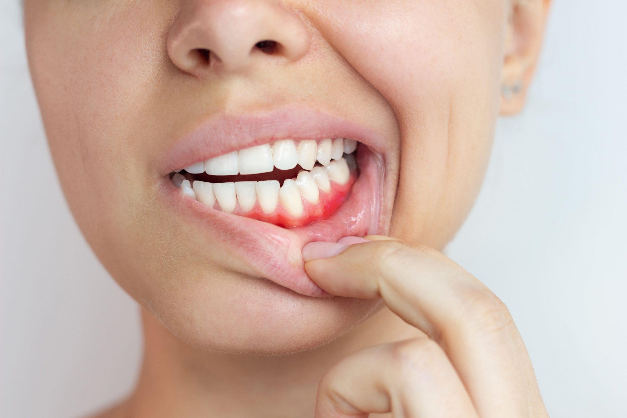 Paciente con encías inflamadas, muestra de la presencia de enfermedad periodontal