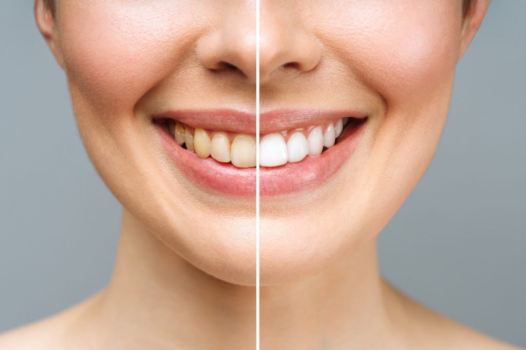 Amedent - Clínica Dental en Valencia|Disfruta de una sonrisa radiante este verano con Amedent: Blanqueamiento dental