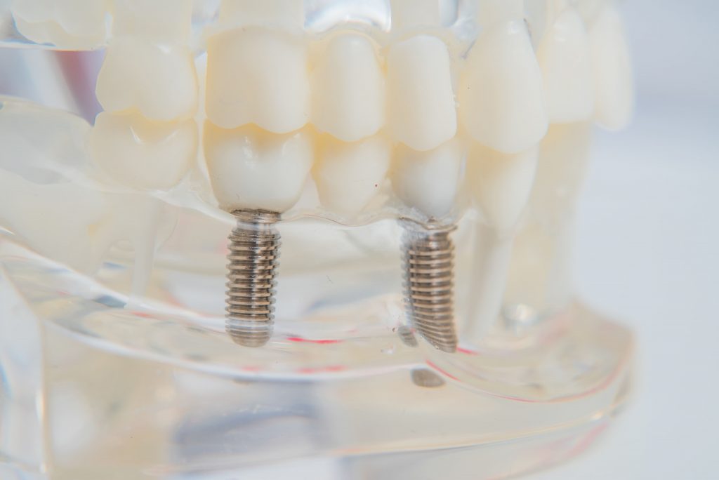 Maqueta dental educativa que muestra la estructura de un implante dental con tornillo de titanio osteointegrado y corona protésica